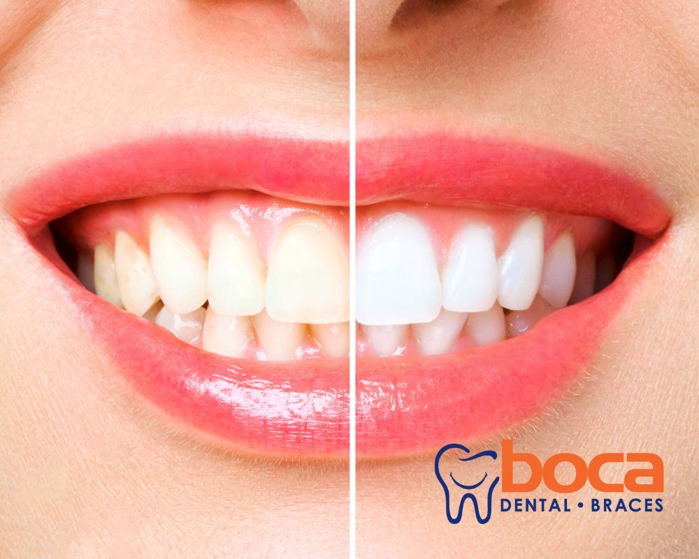 Bright Smiles, Happy Hearts: Teeth Whitening Options at Your Local Dental Clinic